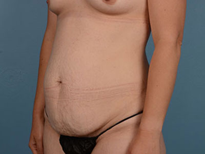 Tummy Tuck Before & After Patient #2007