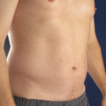 Hi-Def Liposuction Before & After Patient #2268