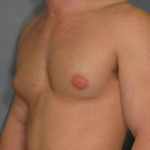 Gynecomastia Before & After Patient #2318
