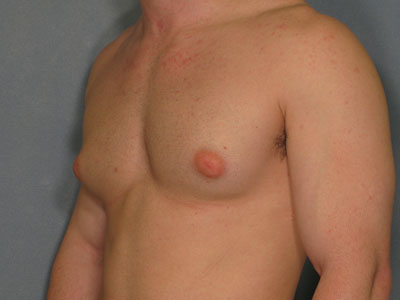 Gynecomastia Before & After Patient #2318