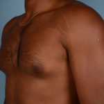 Gynecomastia Before & After Patient #2519