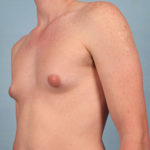 Gynecomastia Before & After Patient #2577