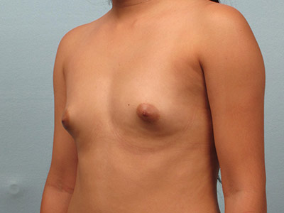 Breast Augmentation Before & After Patient #2609
