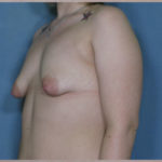 Congenital Breast Deformity Before & After Patient #2603