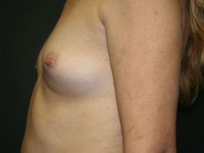 Breast Augmentation Before & After Patient #2688