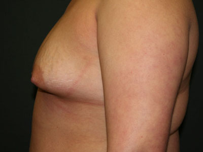 Breast Augmentation Before & After Patient #2697