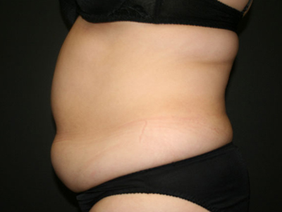 Liposuction Before & After Patient #809