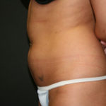 Vaser Liposuction Before & After Patient #814