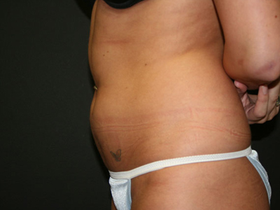 Vaser Liposuction Before & After Patient #814