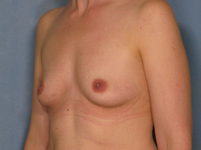 Breast Augmentation Before & After Patient #2836