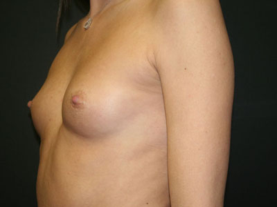 Breast Augmentation Before & After Patient #2843