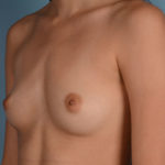 Breast Augmentation Before & After Patient #3067