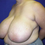 Breast Reduction Before & After Patient #3422
