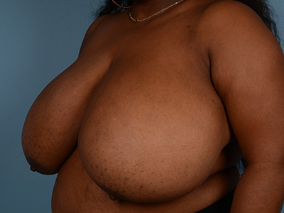 Breast Reduction Before & After Patient #3445