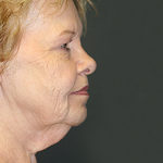 Face & Neck Lift Before & After Patient #4147