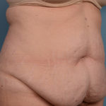 Tummy Tuck Before & After Patient #1230