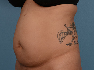 Tummy Tuck Before & After Patient #1252
