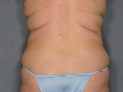 Tummy Tuck Before & After Patient #1429