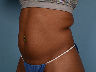 CoolSculpting Before & After Patient #1430