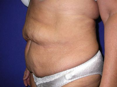 Tummy Tuck Before & After Patient #1531