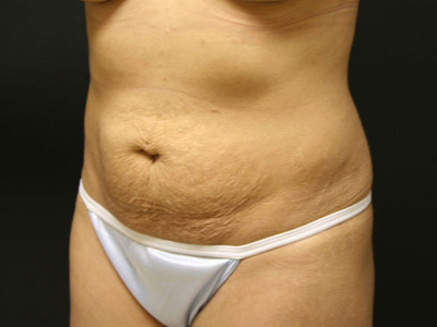 Tummy Tuck Before & After Patient #1570