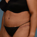 Tummy Tuck Before & After Patient #1907