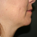 Neck (Submental) Liposuction Before & After Patient #1911