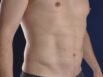 Hi-Def Liposuction Before & After Patient #2268