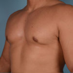 Gynecomastia Before & After Patient #2457