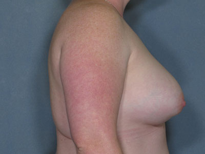 Congenital Breast Deformity Before & After Patient #2676