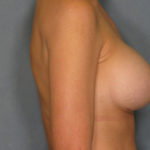 Breast Augmentation Before & After Patient #2867