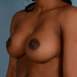 Breast Augmentation Before & After Patient #3115