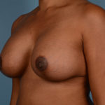 Breast Lift with Augmentation Before & After Patient #3160