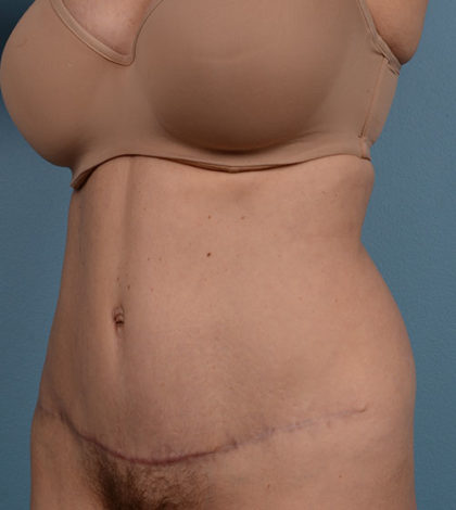 Vaser Liposuction Before & After Patient #877