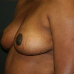 Breast Reduction Before & After Patient #3416