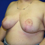 Breast Reduction Before & After Patient #3422