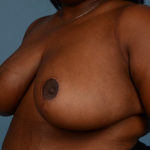 Breast Reduction Before & After Patient #3445