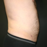 Male Liposuction Before & After Patient #940