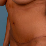 Tummy Tuck Before & After Patient #1274