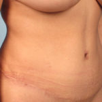 Tummy Tuck Before & After Patient #1288