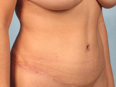 Tummy Tuck Before & After Patient #1288