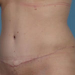 Tummy Tuck Before & After Patient #1344