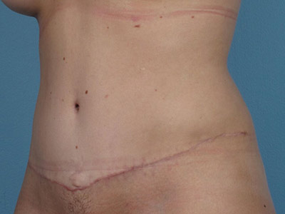 Tummy Tuck Before & After Patient #1344