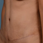 Tummy Tuck Before & After Patient #1394