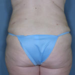 Tummy Tuck Before & After Patient #1429