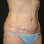 Tummy Tuck Before & After Patient #1484
