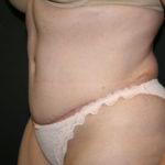 Tummy Tuck Before & After Patient #1586