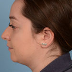 Face & Neck Liposuction Before & After Patient #2006