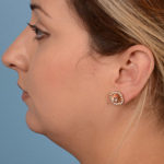 Chin Augmentation Before & After Patient #2216