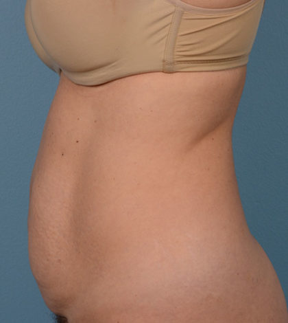 Vaser Liposuction Before & After Patient #2300